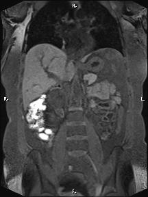 Bilateral adrenal myelolipoma (Radiopaedia 63058-71537 Coronal T1 fat sat 55).jpg