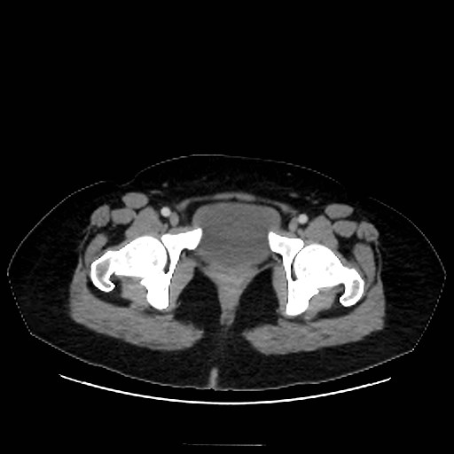 Bilateral adrenal thrombosis (Radiopaedia 58182-65256 A 77).jpg