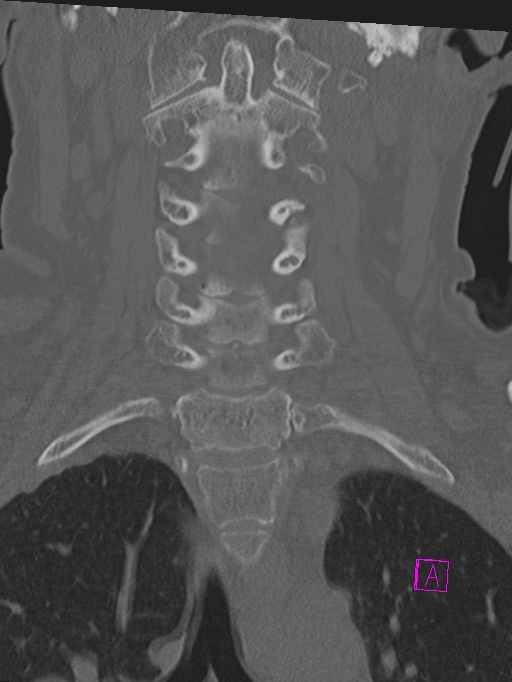 Bilateral atlanto-occipital assimilation (Radiopaedia 28350-28603 Coronal bone window 17).jpg