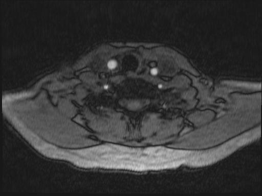 Bilateral carotid body tumors and right glomus jugulare tumor (Radiopaedia 20024-20060 Axial MRA 201).jpg