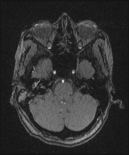 Bilateral carotid body tumors and right glomus jugulare tumor (Radiopaedia 20024-20060 Axial MRA 42).jpg