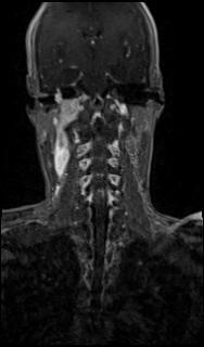 Bilateral carotid body tumors and right glomus jugulare tumor (Radiopaedia 20024-20060 MRA 42).jpg