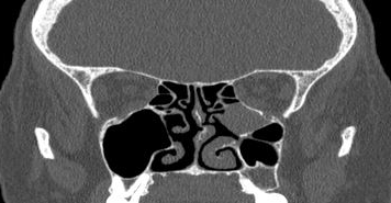 File:Bilateral ectopic infraorbital nerves (Radiopaedia 49006-54084 Coronal 24).png