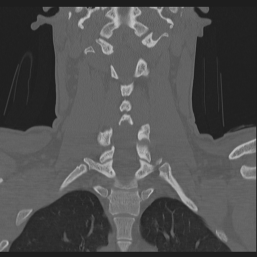 File:Bilateral locked facets (Radiopaedia 33850-35016 Coronal bone window 52).png
