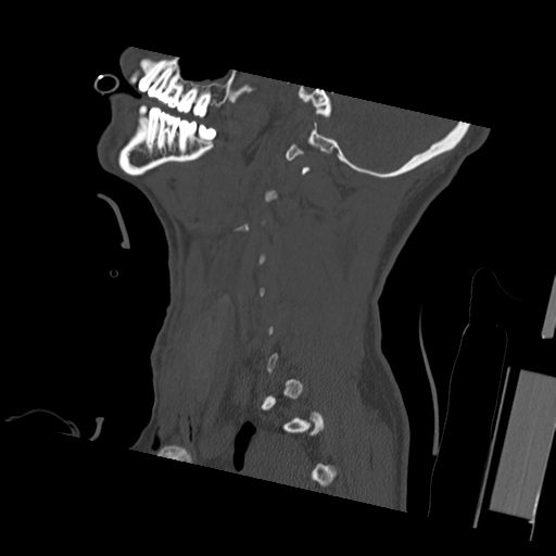 Bilateral locked facets (Radiopaedia 33850-35023 Sagittal bone window 49).png