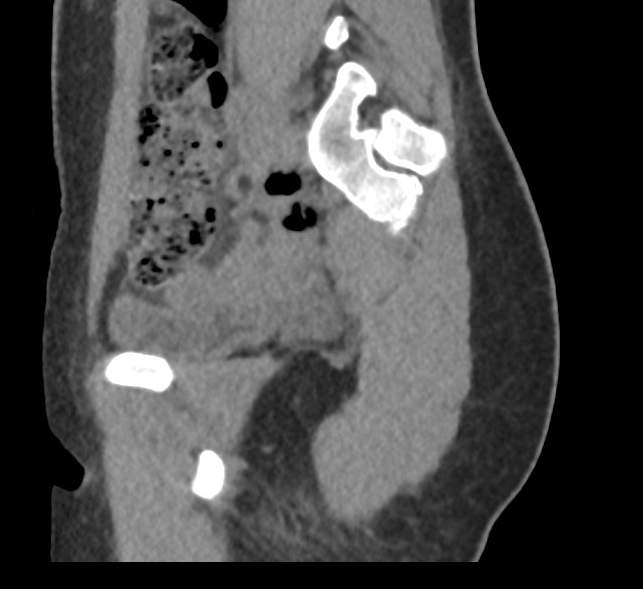 File:Bilateral mature cystic ovarian teratoma (Radiopaedia 88821-105592 D 12).jpg