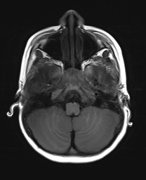 File:Bilateral mesial temporal polymicrogyria (Radiopaedia 76456-88181 Axial T1 4).jpg