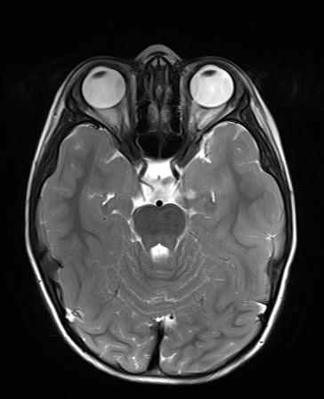 File:Bilateral mesial temporal polymicrogyria (Radiopaedia 76456-88181 Axial T2 8).jpg