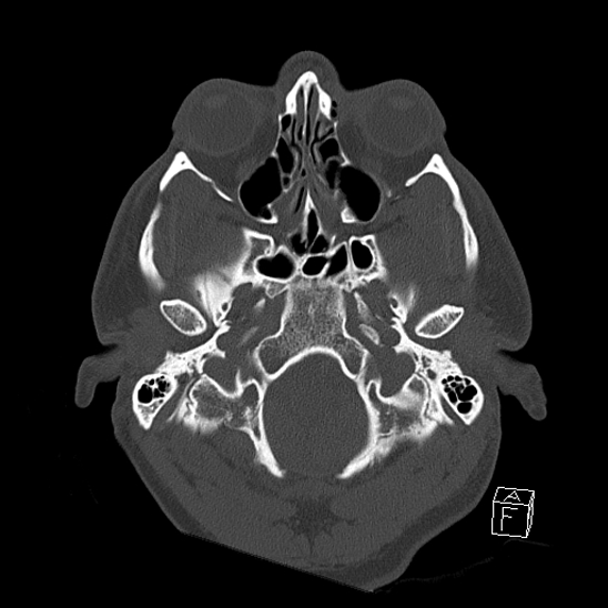 Bilateral occipital condyle fracture (type 2) (Radiopaedia 87675-104089 Axial bone window 17).jpg