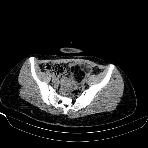 File:Bilateral ovarian dermoid (Radiopaedia 45714-49907 Axial non-contrast 19).JPEG