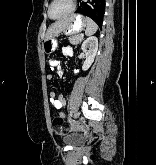 Bilateral ovarian dermoid cysts (Radiopaedia 85785-101603 D 62).jpg