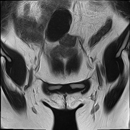 File:Bilateral ovarian endometriomas (Radiopaedia 87085-103347 Coronal T2 3).jpg