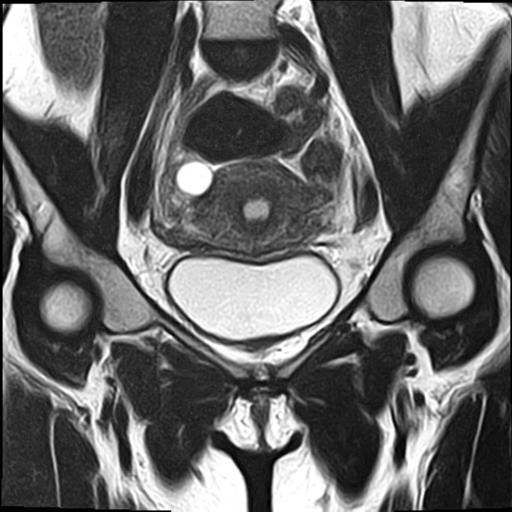 File:Bilateral ovarian endometriomas (Radiopaedia 87085-103347 Coronal T2 7).jpg