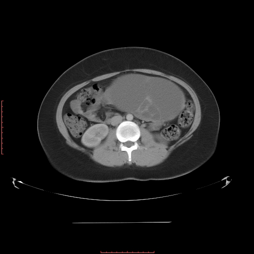File:Bilateral ovarian serous cystadenocarcinoma with right ovarian torsion (Radiopaedia 32640-33611 A 20).jpg