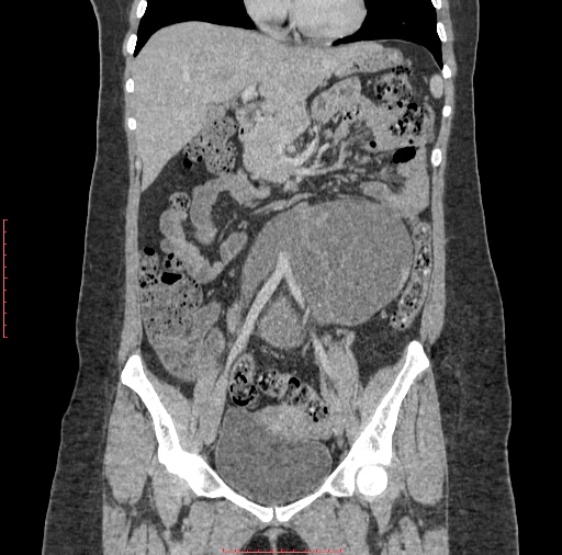 File:Bilateral ovarian serous cystadenocarcinoma with right ovarian torsion (Radiopaedia 32640-33611 B 16).jpg