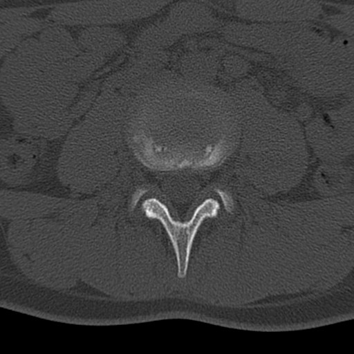 Bilateral pars defect (Radiopaedia 26691-26846 Axial bone window 12).jpg