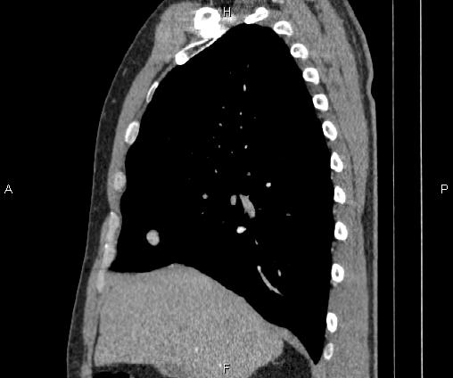Bilateral pulmonary AVM (Radiopaedia 83134-97505 D 43).jpg