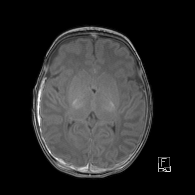 File:Bilateral subdural hemorrhage and parietal skull fracture (Radiopaedia 26058-26190 Axial T1 28).png