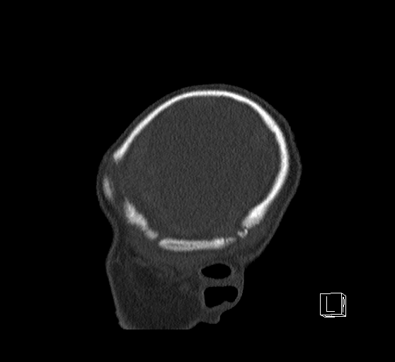 Bilateral subdural hemorrhage and parietal skull fracture (Radiopaedia 26058-26192 Sagittal bone window 9).png