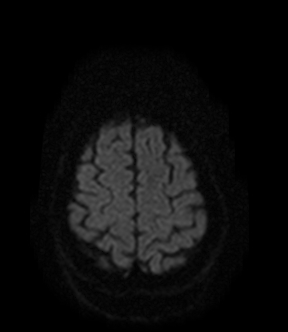 File:Bilateral thalamic glioma (Radiopaedia 65852-75009 Axial DWI 18).jpg
