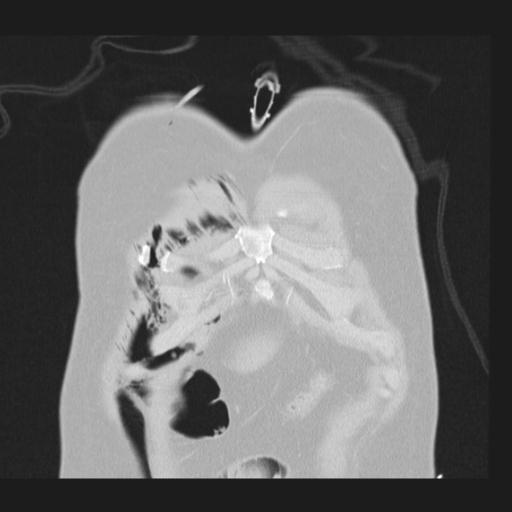 Bilateral traumatic renovascular injury (Radiopaedia 32051-32995 Coronal lung window 7).jpg
