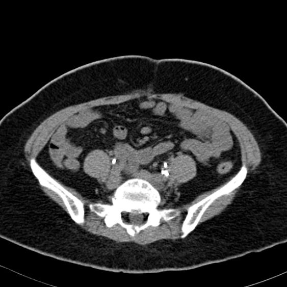 File:Bilateral ureteric stents (Radiopaedia 48795-53825 Axial non-contrast 42).jpg