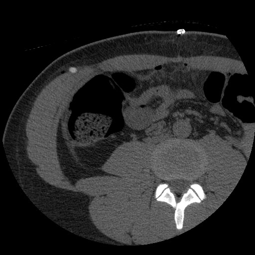 Bile leak from liver traumatic laceration (Radiopaedia 63463-72077 Axial Biliscopin 86).jpg