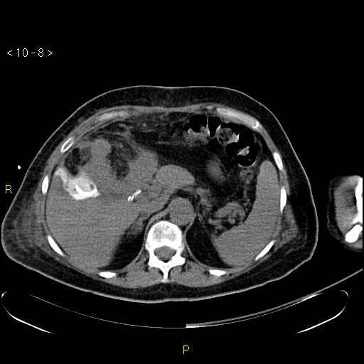 File:Biloma with drainage into the colon (Radiopaedia 20032-20068 B 8).jpg