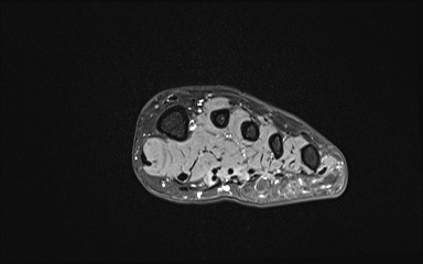 Bipartite hallux sesamoid diastasis (Radiopaedia 77133-89109 Coronal T2 fat sat 17).jpg