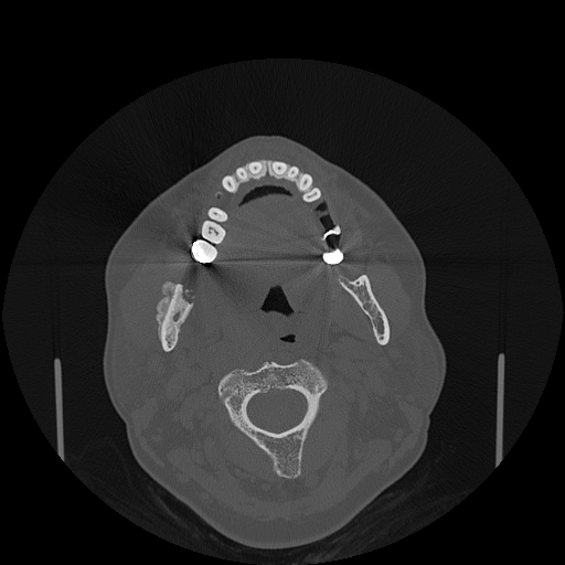 File:Bisphosphonate-related osteonecrosis of the jaw (Radiopaedia 71324-81642 Axial bone window 87).jpg