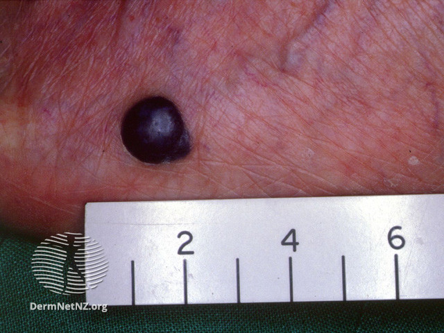 File:Black nodular melanoma (DermNet NZ lesions-mel1).jpg