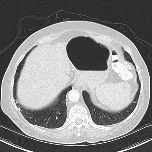 File:Bladder and bowel cancers (Radiopaedia 37688-39592 Axial lung window 45).png