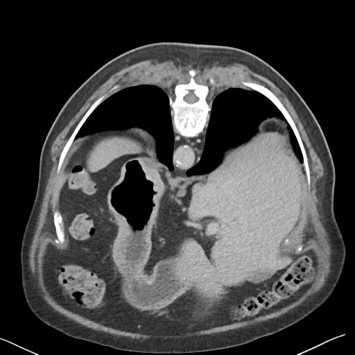 File:Bladder papillary urothelial carcinoma (Radiopaedia 48119-52951 Axial C+ delayed 3).png