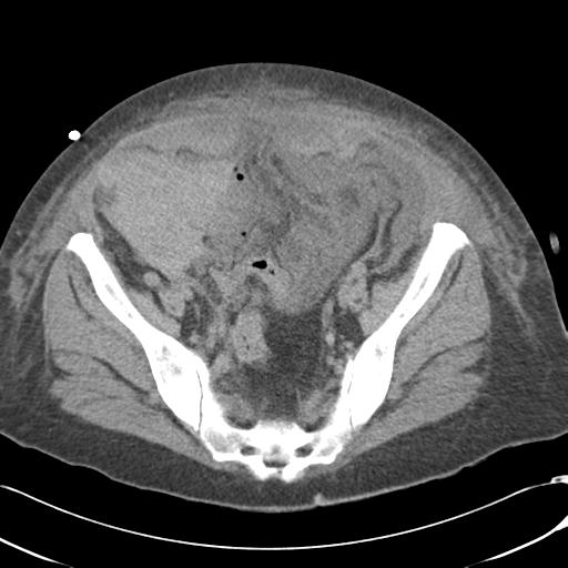 Bladder rupture post renal biopsy (Radiopaedia 30863-31572 Axial non-contrast 69).jpg