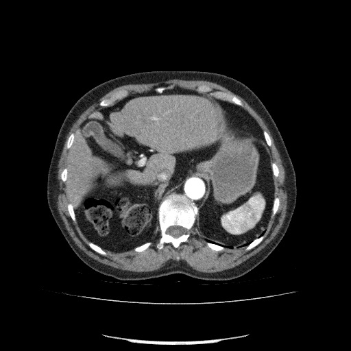File:Bladder tumor detected on trauma CT (Radiopaedia 51809-57609 A 84).jpg