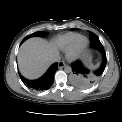 Blunt abdominal trauma with solid organ and musculoskelatal injury with active extravasation (Radiopaedia 68364-77895 Axial C+ delayed 16).jpg
