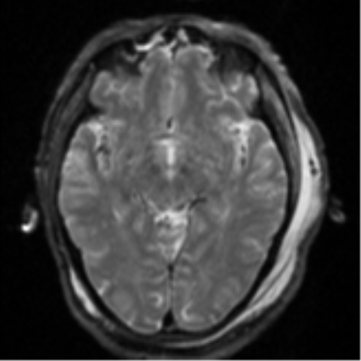 Blunt cerebrovascular injury (Radiopaedia 53682-59745 Axial DWI 14).png