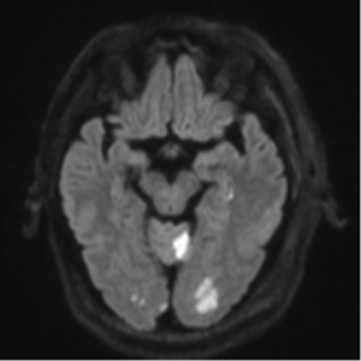 Blunt cerebrovascular injury (Radiopaedia 53682-59745 Axial DWI 43).png