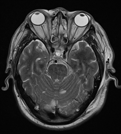 File:Blunt cerebrovascular injury (Radiopaedia 53682-59745 Axial T2 11).png