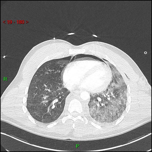 Blunt thoracic trauma (Radiopaedia 73454-84221 Axial lung window 66).jpg
