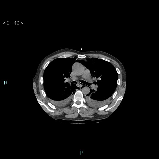 Boerhaave syndrome (Radiopaedia 27683-27897 Axial non-contrast 42).jpg