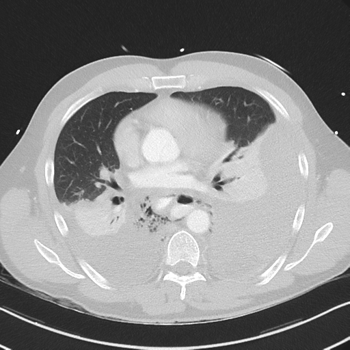 Boerhaave syndrome (Radiopaedia 39382-41661 Axial lung window 30).png