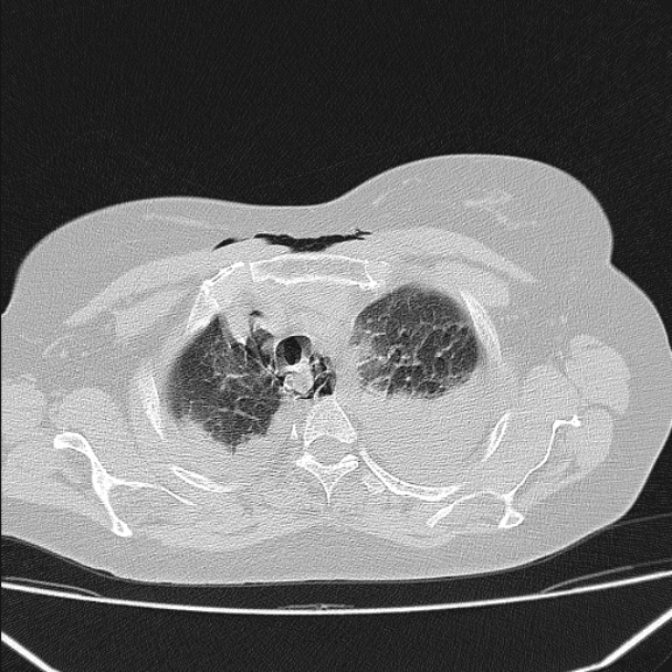 Boerhaave syndrome (Radiopaedia 45644-49799 Axial lung window 40).jpg