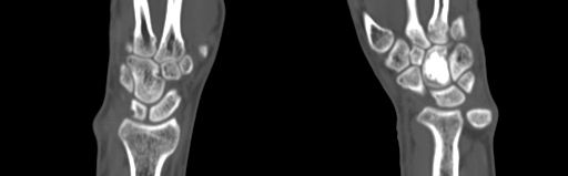 Bone islands - carpus (Radiopaedia 63141-71658 Coronal bone window 35).jpg