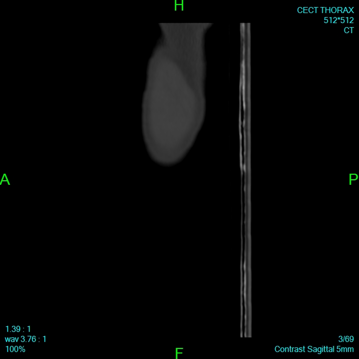 Bone metastases from lung carcinoma (Radiopaedia 54703-60937 Sagittal bone window 3).jpg