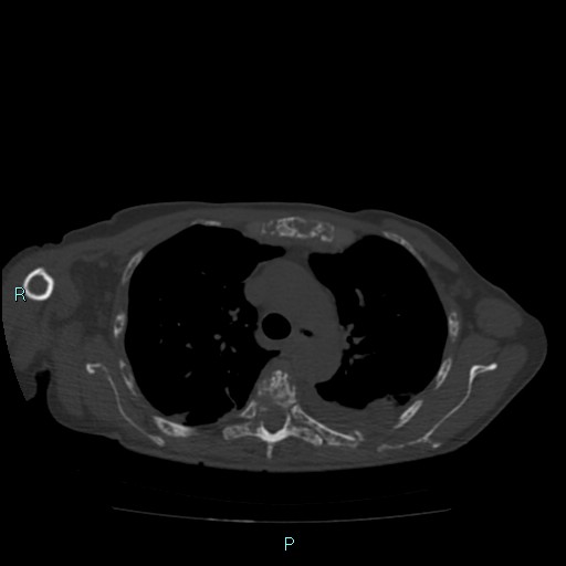 File:Bone metastases from untreated breast cancer (Radiopaedia 42973-46219 Axial bone window 34).jpg