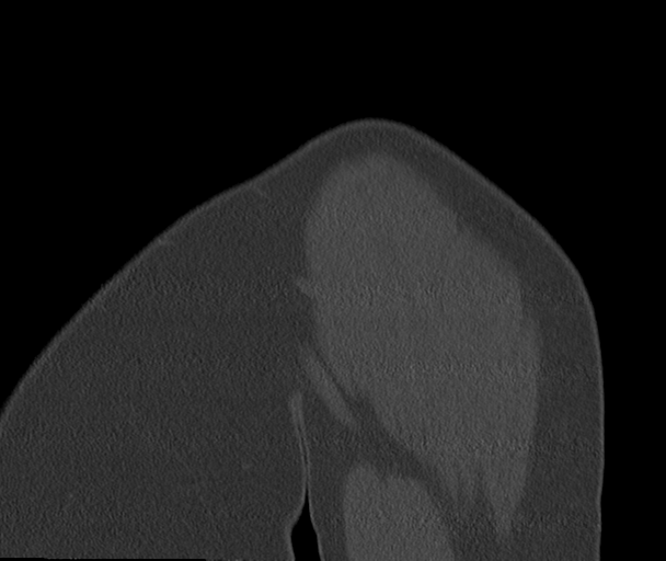 Bony Bankart and Hill-Sachs lesions (Radiopaedia 33622-34727 Sagittal bone window 7).png