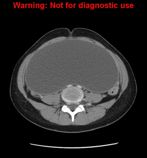 Borderline mucinous cystadenoma of ovary (Radiopaedia 25586-25767 A 52).jpg