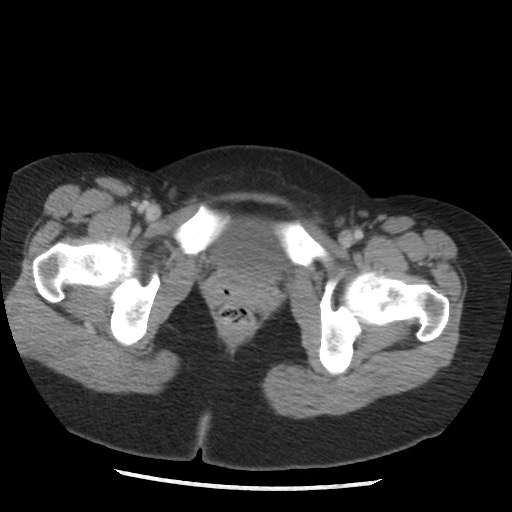 File:Borderline mucinous tumor (ovary) (Radiopaedia 78228-90808 A 138).jpg