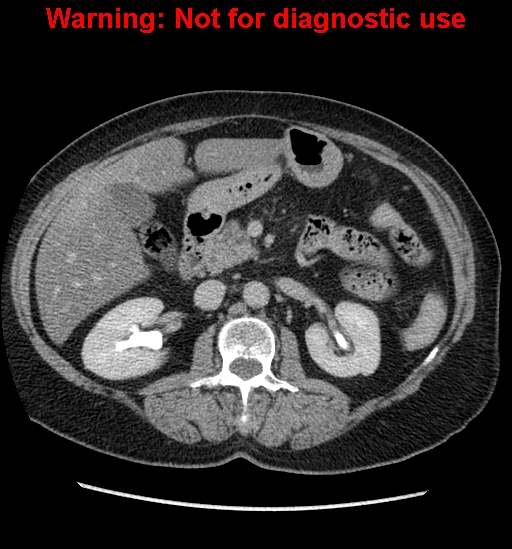 File:Bosniak renal cyst - type II (Radiopaedia 23404-23468 F 23).jpg